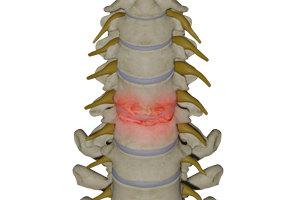 Cervical Degenerative Disorder