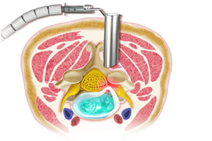 Cervical Microdiscectomy