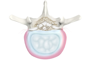 Degenerative Disc Disease