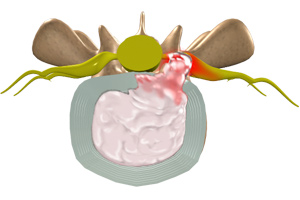 Disc Herniation