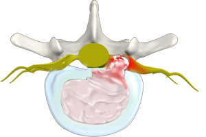 Herniated Disc (Lumbar)