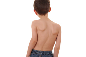 Scoliosis in Children