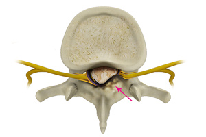 Spinal Stenosis