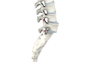 Spondylolisthesis