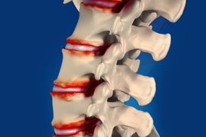 Degenerative Spine Surgery
