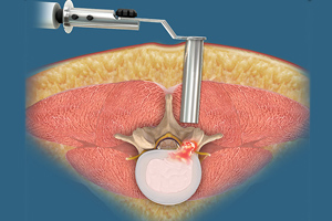 Lumbar Microdecompression