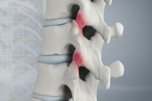Spine Arthritis