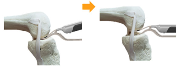 Outpatient Robotic Knee Replacement