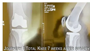 Rapid recovery with Same Day Journey II Total Knee Replacement pic