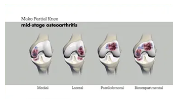 Partial Knee Robotic Assisted Surgery Mako