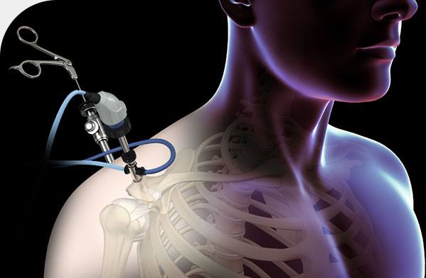 arthroscopic-surgery