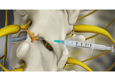 Spinal Injection