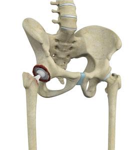 Failed Hip Replacement Revision Surgery pic