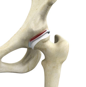 Hip Labral / Labrum Tears pic