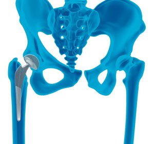Loose Hip Replacement Revision pic