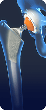 Joint Replacement
