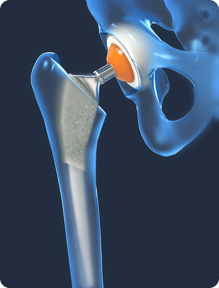 Joint Replacement Solutions
