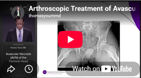 Arthroscopic Treatment of Avascular Necrosis (AVN) of the Femoral Head