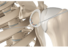 Bony Instability Reconstruction of the Shoulder