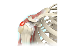 Calcification Tendinitis