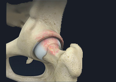 Femoroacetabular Osteoplasty