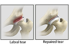 Hip Labral Repair