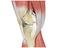 Knee Ligament Injuries