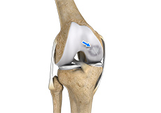 Osteochondral Defect of the Knee