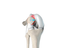 Patellar Tracking Disorder/Patellar Maltracking