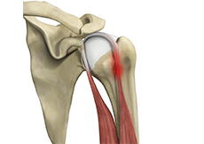 Proximal Biceps Tendinitis