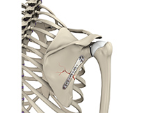Shoulder Fracture Care