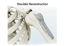 Shoulder Reconstruction Surgery