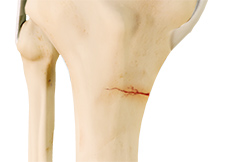 Stress Fracture of the Tibia