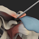 ac-joint-stabilization