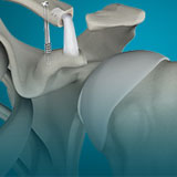 acromioclavicular-joint-reconstruction