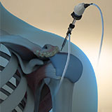 arthroscopic-acromioplasty