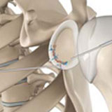 arthroscopic-bankart-repair