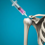 intraarticular-shoulder-injection