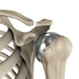 partial-shoulder-replacement