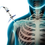 shoulder-arthroscopy