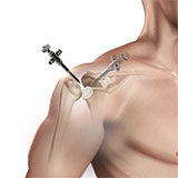 shoulder-reconstruction-surgery