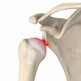 shoulder-stabilization
