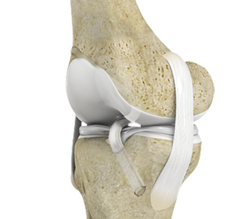 ACL Reconstruction