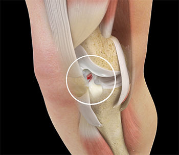 ACL Tears
