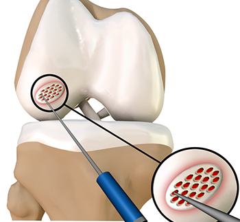 Cartilage Microfracture
