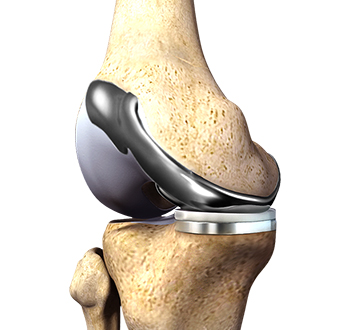 Custom Knee Replacement