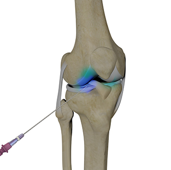 Intraarticular Knee Injection