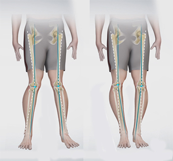 Knee Angular Deformities