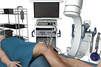 Knee Arthroscopy