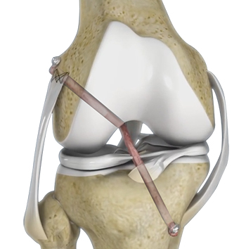 Knee Ligament Reconstruction